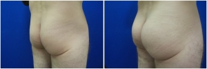 buttock-implants-12-4