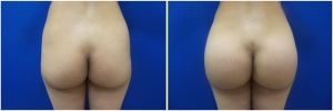 buttock-implants-14-1