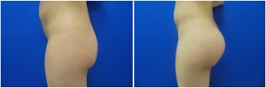 buttock-implants-14-2
