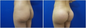 buttock-implants-14-3