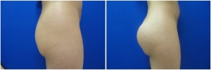 buttock-implants-14-4