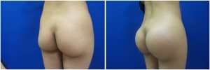 buttock-implants-14-5