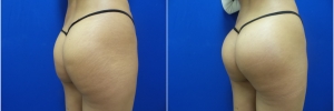 buttock-implants-2