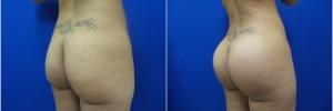 buttock-implants-2