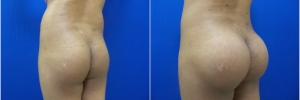 buttock-implants-2