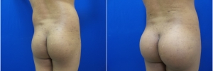 buttock-implants-3