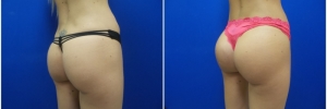 buttock-implants-5-3