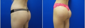 buttock-implants-5-4