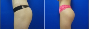 buttock-implants-5-5
