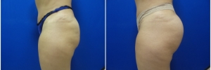 buttock-implants-7-1