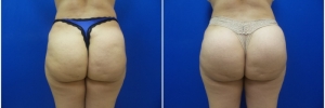 buttock-implants-7-2