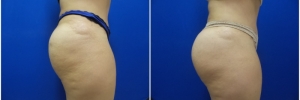 buttock-implants-7-3