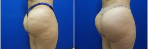 buttock-implants-7-4