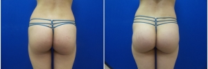 buttock-implants-8-2