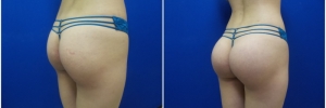 buttock-implants-8-3