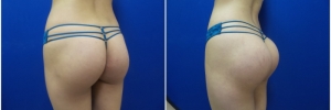buttock-implants-8-4