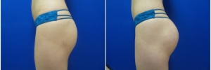 buttock-implants-8-5