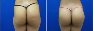 buttock-implants-9-1