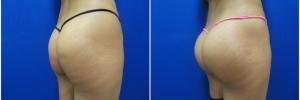 buttock-implants-9-2