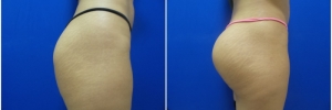 buttock-implants-9-3