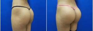 buttock-implants-9-4
