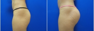 buttock-implants-9-5