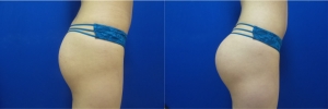 buttock-implants-before-after-16-1