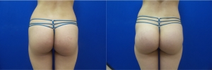 buttock-implants-before-after-16-2