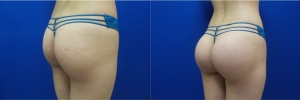 buttock-implants-before-after-16-3