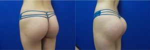 buttock-implants-before-after-16-4