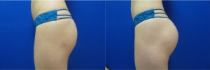 buttock-implants-before-after-16-5