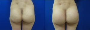 buttock-implants-before-after-17-1