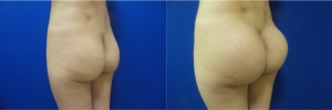 buttock-implants-before-after-17-2