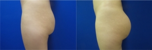 buttock-implants-before-after-17-3