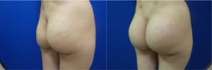 buttock-implants-before-after-17-4