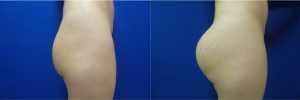 buttock-implants-before-after-17-5