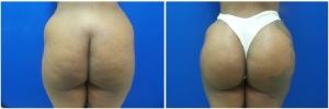 buttock-implants-before-after-18-1