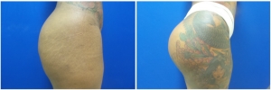 buttock-implants-before-after-18-2