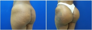 buttock-implants-before-after-18-3