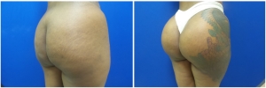 buttock-implants-before-after-18-4