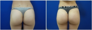 buttock-implants-before-after-19-1