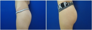 buttock-implants-before-after-19-2