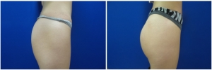 buttock-implants-before-after-19-3
