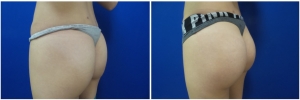 buttock-implants-before-after-19-4