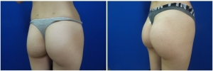 buttock-implants-before-after-19-5