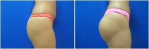 buttock-implants-before-after-20-1