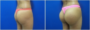 buttock-implants-before-after-20-2
