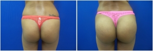 buttock-implants-before-after-20-3