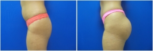 buttock-implants-before-after-20-4