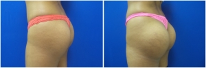 buttock-implants-before-after-20-5